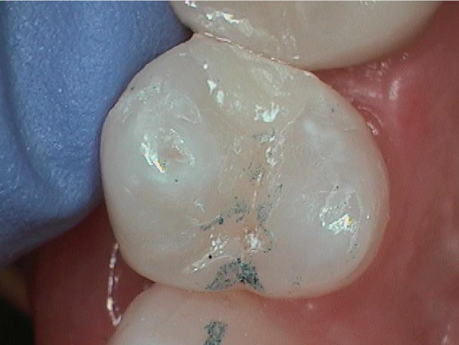 Tooth Colored Fillings NYC: Dr Sachar